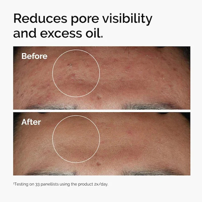 Korean Niacinamide 10% + Zinc Serum — Pore Minimizer & Glow